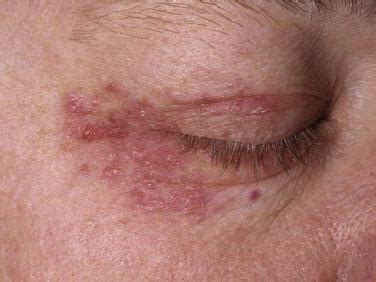 hermes am auge|herpes in den augen bilder.